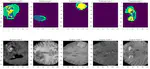 3D Brain tumor segmentation