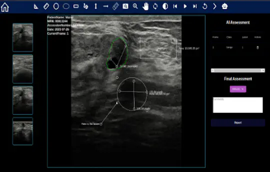 Computer-Aided System based-Deep Learning for Physician Support in Malignancy Score Decision in Breast Ultrasound Imaging